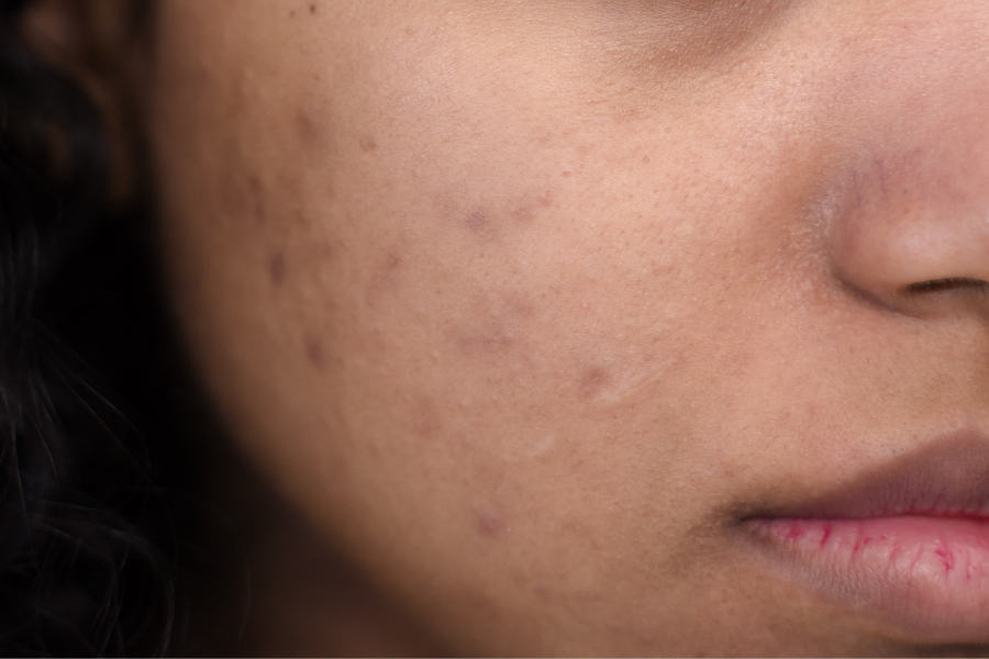 dark spots on women face